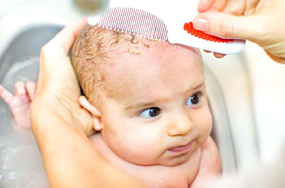 How to Get Rid of Cradle Cap FamilyEducation